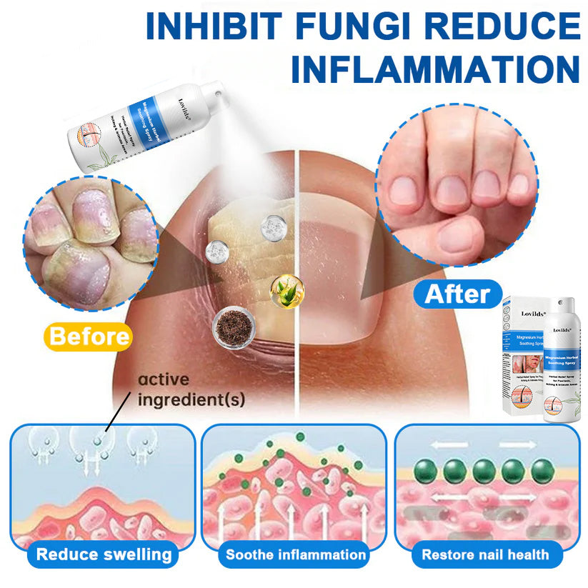 ✅ Official Store: Lovilds® Magnesium Herbal Psoriasis Spray ⚕ FDA Certified (Relieves psoriasis and eczema, improves bacterial infections in the genital area, treats acne and warts, relieves joint pain and neuropathic pain)