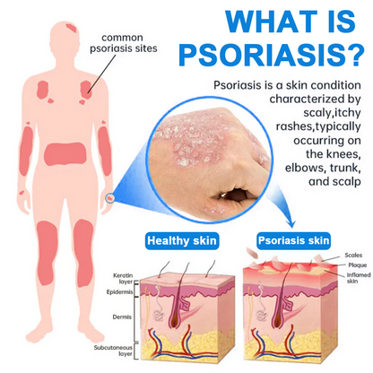 ✅ Official Store: Lovilds® Magnesium Herbal Psoriasis Spray ⚕ FDA Certified (Relieves psoriasis and eczema, improves bacterial infections in the genital area, treats acne and warts, relieves joint pain and neuropathic pain)